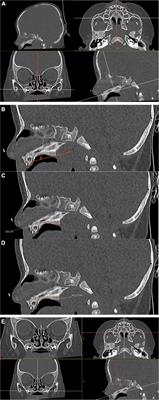 The Ogival Palate: A New Risk Marker of Sudden Unexpected Death in Infancy?